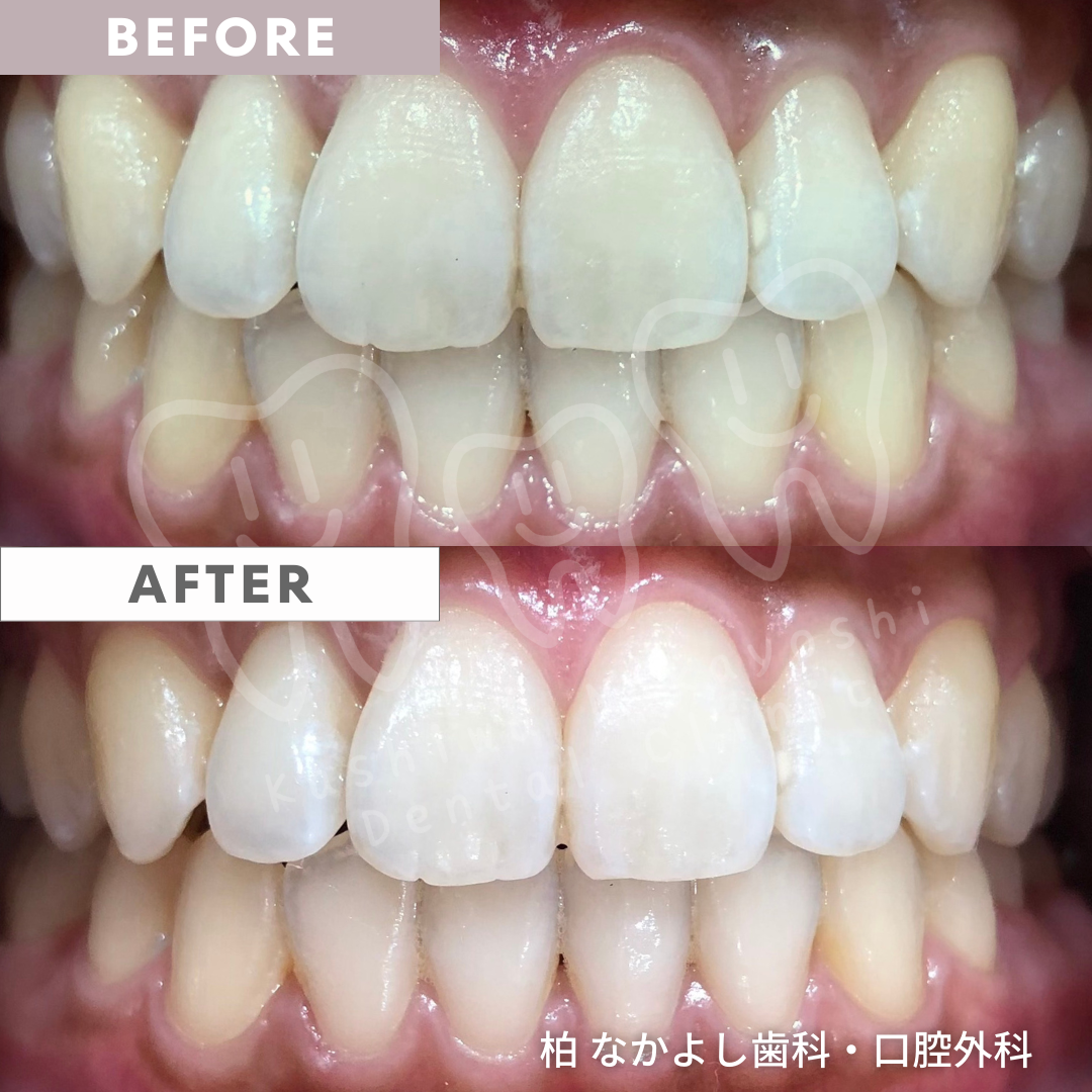 ホワイトニング　症例写真